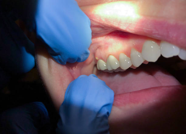 Best Emergency Dentist for Knocked-Out Tooth in Monee, IL